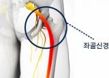 엉덩이, 골반이 아플때 - 좌골신경통 원인&증상