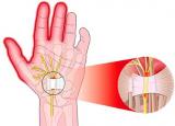 방아쇠수지증후군 - 손가락통증원인과 증상