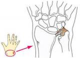 	삼각섬유연골파열 증상과 원인 - 손목연골 치료방법 