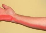 팔꿈치터널증후군 증상 - 약지, 새끼손가락저림