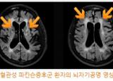 이차성 파킨슨증후군과 비전형성 파킨슨증후군