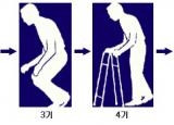 파킨슨병 초기증상 - 4대증상과 진행단계