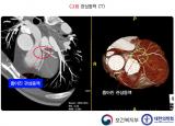 협심증 검사방법 - 심전도, 방사선, 초음파, CT, 조영술